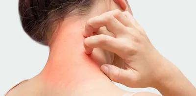 Аллергия на коже: мазь от аллергии на коже, таблетки - аллергия на коже  лечение | Doc.ua