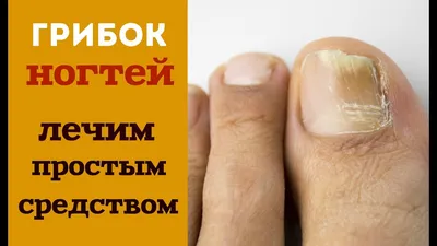 Грибок ногтей, лечение. Причины и симптомы грибка ногтей.