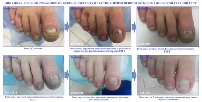 Удаление и лечение грибка ногтей лазером на ногах и руках в  Санкт-Петербурге в клинике Medclub: цены и отзывы пациентов.