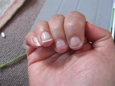 Как вылечить грибок ногтей