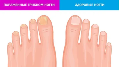 Грибок ногтей (онихомикоз) лечение и профилактика.