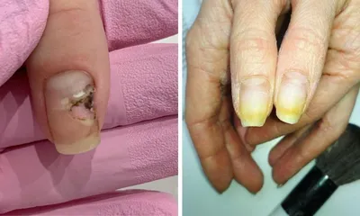 Грибок ногтей: причины, ранние симптомы и эффективные способы лечения |  Здоровье | WB Guru