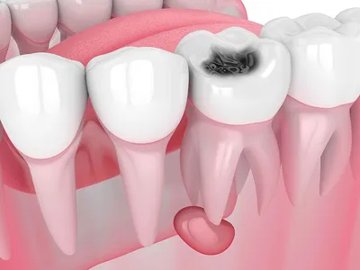 Варианты имплантации зубов нижней челюсти - Diamond Dent