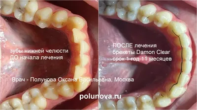 Тотальное восстановление зубов верхней челюсти и множественного отсутствия  зубов на нижней, с реабилитацией временными коронками - Эстетика