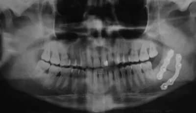 MVT уменьшение нижней челюсти в Корее | Контурная пластика лица 【ID  Hospital】