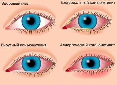Коррекция формы глаз | Lunifera