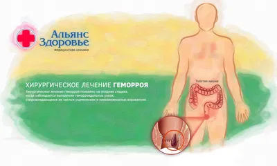 Лечение геморроя в Одессе: современные методы и подходы в Клинике ОМД 2024  - ОМД Клиника