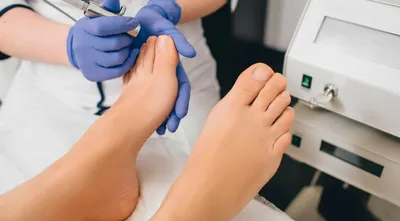 Как долго лечится грибок на ногах? | Московская Клиника Подологии