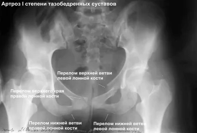 Анатомия: Соединения костей таза