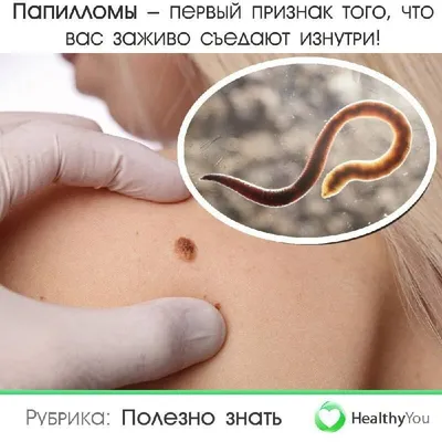 Если на вашем теле есть папилломы - на шее, подмышках или в любых других  местах – паразиты поедают ваши органы! Наличие папиллом на коже… | Instagram