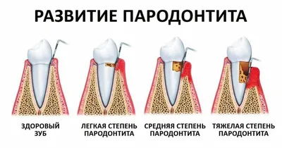 Лечение пародонтоза десен и зубов — цены в Москве