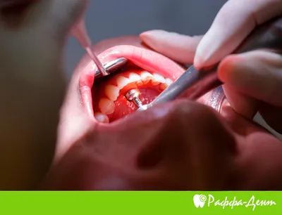 Пародонтоз и протезирование зубов: совместимы или нет?