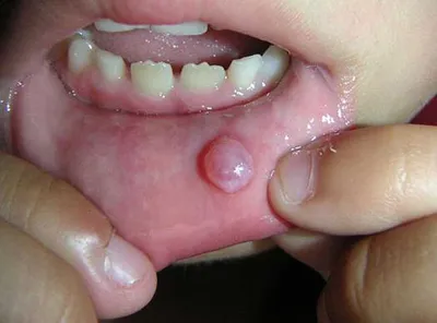 Онколог перечислил симптомы рака полости рта
