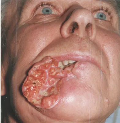 Рак полости рта | Здоровый Гродно