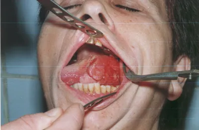 Кокаин повреждения его нос и лицо | Д-р Фрэнсис Pilolli