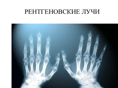 рентгеновские лучи позвоночника. пациенты, страдающие колиозом Стоковое  Изображение - изображение насчитывающей колонка, диск: 264895187