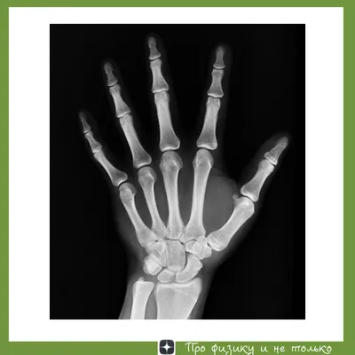 рентгеновские лучи и МР-сканирование пациента с хронической слабостью  верхних конечностей, показывающие гернифицированное ядро пул Стоковое  Изображение - изображение насчитывающей магнитно, диагноз: 229301581