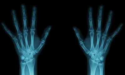 Что такое рентгеновские лучи? | pochemuchka | Дзен
