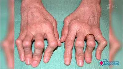 Ревматоидный артрит: симптомы, диагностика, лечение