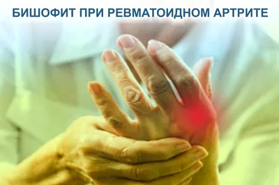 Ревматоидный артрит: лечение микромоторами – экспертный материал, Lahta  Clinic