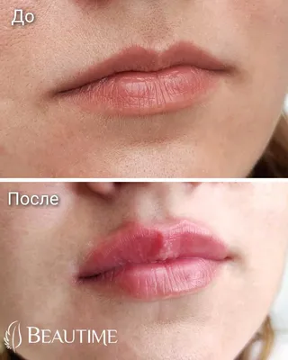 Увеличение губ: что нужно знать о процедуре