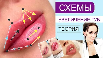 Увеличение губ филлером (коррекция губ): стоит ли, виды, рекомендации, что  нельзя делать, лучшие препараты в клинике красоты Bellezza Киев