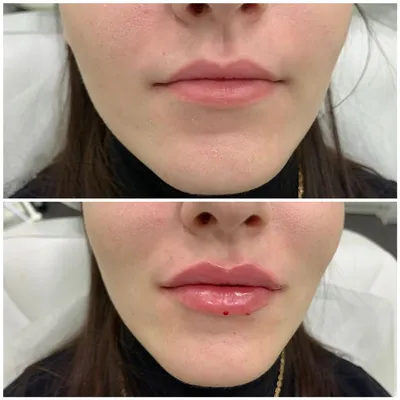 Увеличение губ в Зеленограде в салоне красоты - НИКА BEAUTY