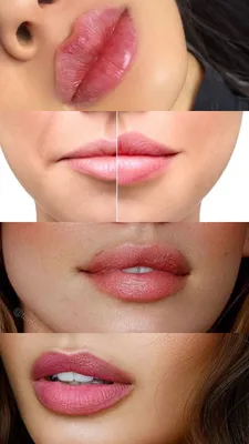 Увеличение губ: ответы врача на популярные вопросы — VICLINICS