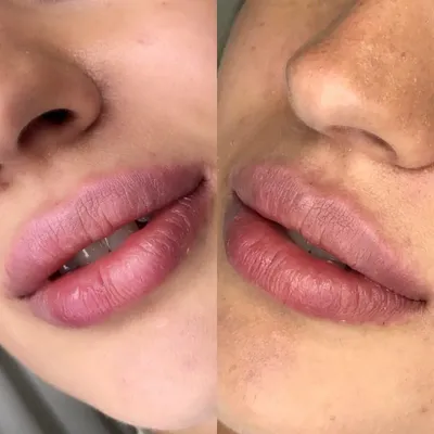 Для тех, кто за естественное увеличение губ 😍 Если вы хотите объемные,  естественные губы без утиного эффекта, то вам к нам😍 Фотка сделана… |  Instagram