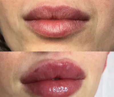 Увеличение губ - Milar Clinic