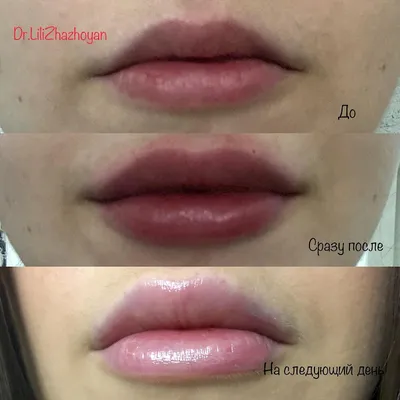 Увеличение губ, инъекции гиалуроновой кислоты Краков