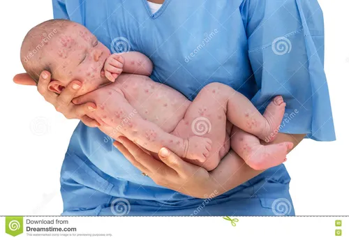 Краснуха Фото ребенок на больничной койке