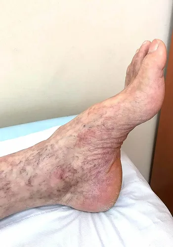 Сыпь При Онкологии Фото нога человека на кровати