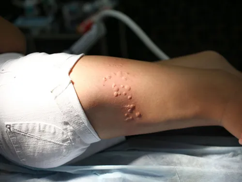 Грибковый Дерматит Фото крупный план раны на руке человека