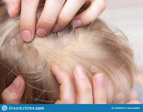 Грибковый Дерматит Фото крупный план рук, держащих волосы ребенка