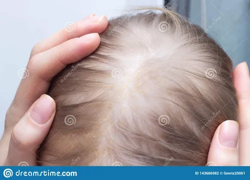 Грибковый Дерматит Фото человек, держащий волосы