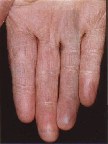 Ксантомы Фото рука человека крупным планом