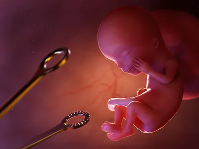 Аборт: сроки, типы, последствия | Лечение и консультация в СПб