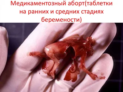 Клиника \"Альфамед\" - Медикаментозный аборт