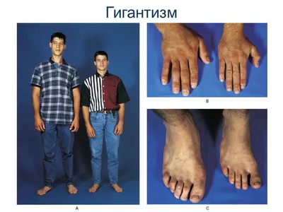 Пальцы становились кривыми, руки — огромными, нога выросла с 37-го до 41-го  размера». Как живут и борются за лекарства люди с акромегалией | Такие дела  Такие дела