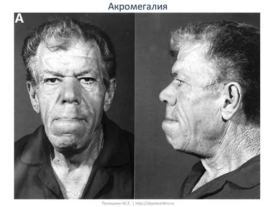 Акромегалия, акромегалия симптомы, болезнь Валуева - 4 сентября 2021 -  НГС.ру