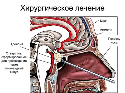 Акромегалия - тяжелое заболевание, о котором нужно помнить | Эндокринолог  online | Дзен