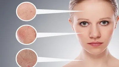 Аллергия на коже лица: виды аллергической сыпи у взрослого, лечение и фото,  чем лечить, снять реакцию, что делать с прыщами, как убрать и избавиться,  причины сильных высыпаний на шее