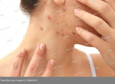 Аллергическая сыпь на лице, руках, теле - основные причины, потенциальные  болезни, лечение