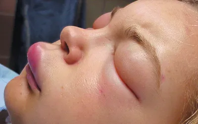 Аллергия на лице лечение, что делать когда на лице высыпания — Fenkarol®