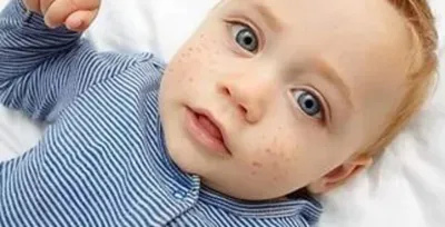 Может ли аллергия на порошок проявляться только покраснением на лице? — 13  ответов | форум Babyblog