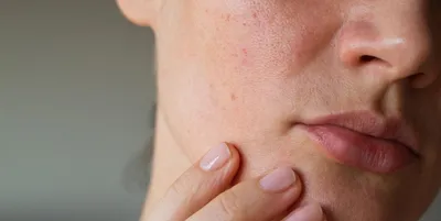 Сыпь на лице у новорожденного: причины появления сыпи на лице, голове и  шее, возможное лечение