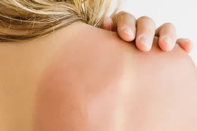 Аллергия на солнце. Как защитить кожу и что делать, если она уже пострадала?