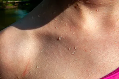 Аллергия на солнце: симптомы, лечение и что делать, если появилась аллергия  на солнце: Уход за собой: Забота о себе: Lenta.ru