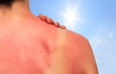 Лето им противопоказано: врач рассказала, как проявляется аллергия на солнце